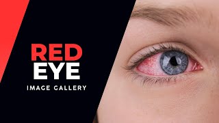 Red Eye Image Gallery [upl. by Pegeen]