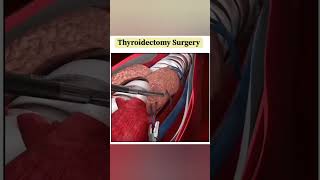 thyroid surgery 3d animation।।thyroidectomy surgery and recovery।।shorts ytshorts thyroid [upl. by Anal]