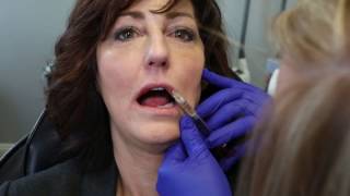 Watch Volbella Injection  Full Procedure [upl. by Ennairol]