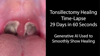 Healing Time Lapse After Tonsillectomy 029 Days in 60 Seconds [upl. by Ube]