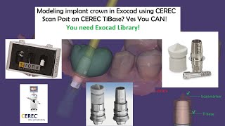 Sirona CEREC ScanPost and Cerec Tibase in Exocad How to model crown or abutment [upl. by Eiboh]