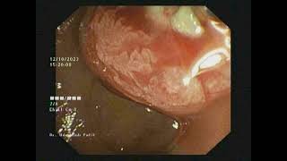 Pancreatic Duct PD Dilatation [upl. by Jensen34]