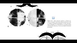 Kanski Clinical Ophthalmology Made Easy  Neuroophthalmology 11 Retrochiasmal Lesion [upl. by Rein]