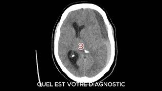 HEMATOME SOUS DURAL CHRONIQUE radiologystudent hospitalityeducation [upl. by Tichon]