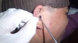 Earwax Removal and Suctioning of Ear Fungus Otomycosis [upl. by Anma]