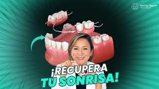 ¡Descubre el Secreto de la Prótesis Dental Removible [upl. by Nellad198]