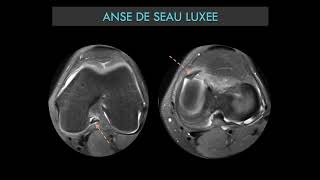 Imagerie du Genou  Ménisque  Ligament Cartillage [upl. by Hogan]