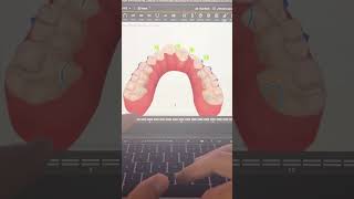 TIP 296  SKELETAL EXPANDER AND ALIGNERS [upl. by Cassandre]