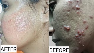 Tretinoin Cream Routine [upl. by Lagiba]