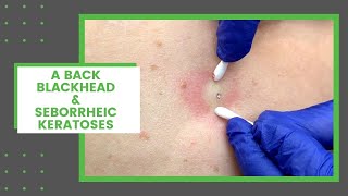 A Back Blackhead amp Seborrheic Keratoses  Dr Derm [upl. by Taryn718]