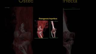 Osteogenesis Imperfecta [upl. by Santa294]