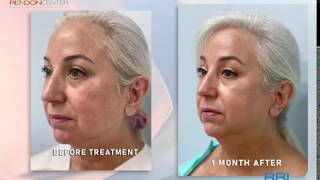 Before amp After Results of BBL IPL Laser Rendon Center Patient [upl. by Airdnekal]