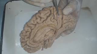 External Features of the Cerebrum 3 Neuroanatomy [upl. by Ahsien]