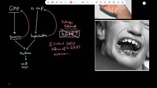 LeschNyhan syndrome  Pathology [upl. by Akemahc168]