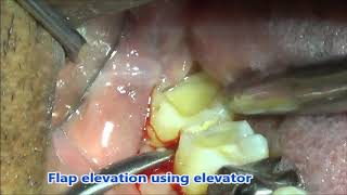 Attrited lower wisdom tooth removal [upl. by Ingalls]