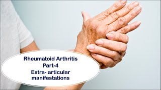 Rheumatoid arthritis Part4  Extraarticular manifestations [upl. by Sirhc]