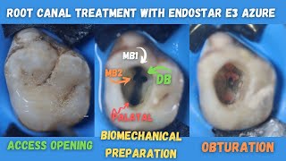 Root Canal Treatment 🟠 Maxillary First Permanent Molar 🔵 Endostar E3 Azure 🟡How to find Mb1 amp Mb2 [upl. by Merla]