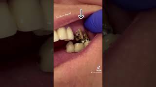 Removing … OLD Dental Bridge [upl. by Lsil405]