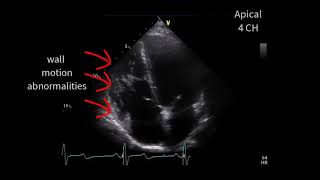 A special cardiomyopathy [upl. by Sesiom]