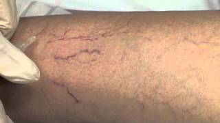 Spider Vein Sclerotherapy [upl. by Algie]