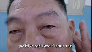 Positive perilymph fistula test [upl. by Soiritos]