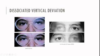 Essential Infantile Esotropia Characteristics [upl. by Alfonso474]