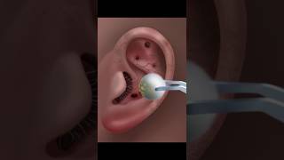 ASMR Ear Cleaning amp Treatment for Ultimate Relaxation asmr satisfying animation tretment [upl. by Essy]