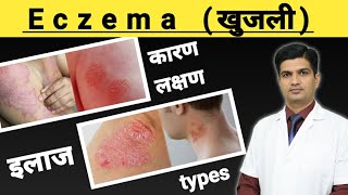 Eczema Treatment  Eczema kya hota hai [upl. by Atiuqrahc]