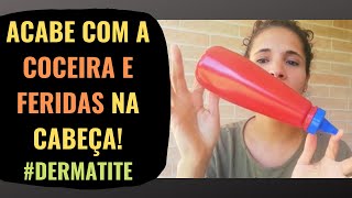 ELIMINE a Coceira e Feridas na cabeça dermatite [upl. by Anallese]