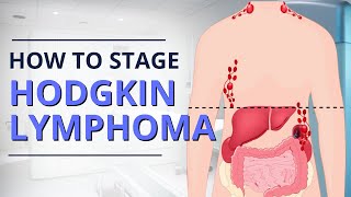 Hodgkin Lymphoma Staging From Diagnosis to Prognosis  The Patient Story [upl. by Dann]