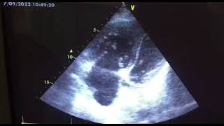 Right ventricular dualthrombi attaching to the chordae tendineae a case report [upl. by Tierell]