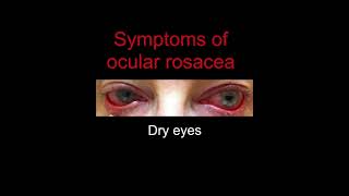 Ocular Rosacea [upl. by Joon]