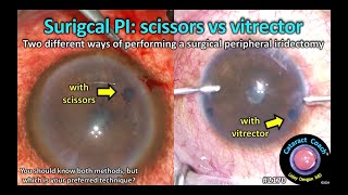 CataractCoach™ 2170 surgical peripheral iridectomy with scissors or vitrector [upl. by Clercq]