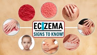 quotEczema Explained Symptoms Causes amp Treatmentsquoteczema skincare [upl. by Ecnerrot]