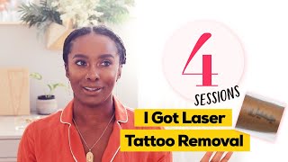 Amazing Laser Tattoo Removal Results [upl. by Eissat]