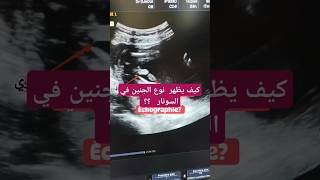 كيف يظهر نوع الجنين في السونار échographie؟؟ حمل حامل baby [upl. by Sharl]