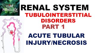 ACUTE TUBULAR INJURYNECROSIS or ACUTE KIDNEY INJURY  Pathology [upl. by Hannahs]