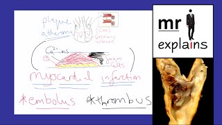 mr i explains How atheroma fat plaques form and lead to Myocardial Infarctions heart attacks [upl. by Tamaru]