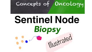 Sentinel node biopsy  A simple way to Understand [upl. by Siderf]