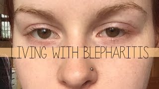 Living with Blepharitis [upl. by Sosthena319]