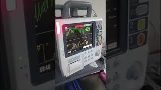 Reversão de taquicardia supraventricular com manobra de Valsalva modificada cardiologia [upl. by Oiramal]