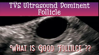 TVS Ultrasound Dominent Follicular Study  14 Day Follicular monitoring  What is GOOD Follicle [upl. by Notlih]