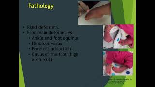 Common pediatric foot deformities first part [upl. by Tiossem440]