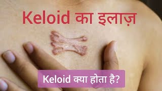 Keloid का इलाज  Hypertrophic Scar  Keloid treatment  keloid injection treatment  keloid scar [upl. by Senilec]