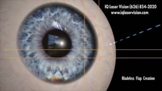 Z LASIK How Bladeless Eye Surgery Works [upl. by Eiuqnom]