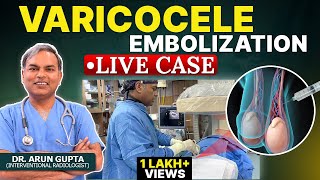 Live Case  Grade 3 Varicocele Embolization  NonSurgical Treatment of Varicocele  Dr Arun Gupta [upl. by Lecroy268]