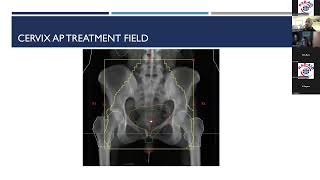 Radiation Therapy Treatment Planning Workshop  Pelvis Planning by RADAID International [upl. by Chester436]