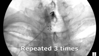 Cervical Interlaminar Epidural Steroid Injection  ThePainSourcecom [upl. by Amasa]