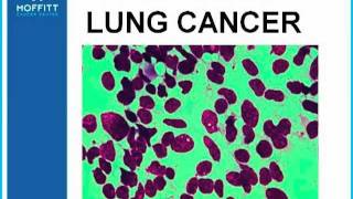 GRACEcast076LungCancerASCO 2011 Highlights  SCLC Early Stage NSCLC and Mesothelioma [upl. by Kohler]