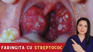 Faringita cu STREPTOCOC Tot ce trebuie sa stii [upl. by Odlaner]